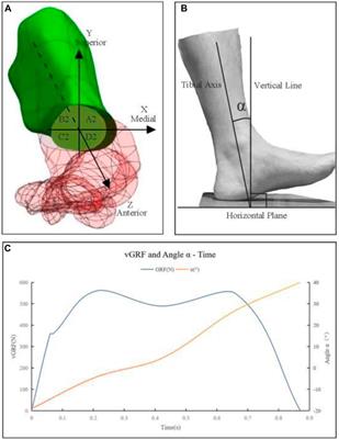 Stability of osteotomy in minimally invasive hallux valgus surgery with “8” shaped bandage during gait: a finite element analysis